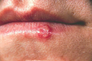 Herpes simplex virus type 1 causes cold sores on or around the lip