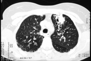 An example of severe ABPA with bronchiectasis and lung inflammation
