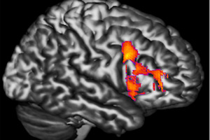 A person with bipolar disorder activating their dorsal frontal cortex 