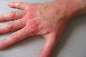 Hand dermatitis | DermNet New Zealand