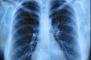 The test could match lung cancer patients to the right treatment