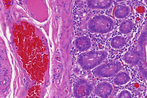 Image of human intestine from patient with inflammatory disease