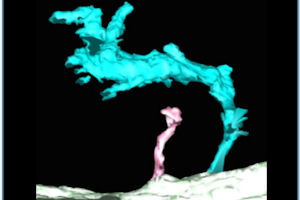 A 'super-tubule' (cyan) compared with a healthy t-tubule (pink)