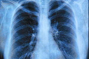 Lung cancer is the most common cause of cancer deaths
