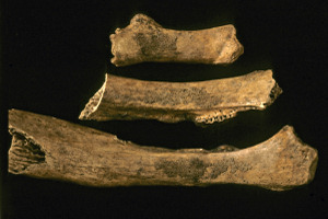 Ribs showing evidence of tuberculosis